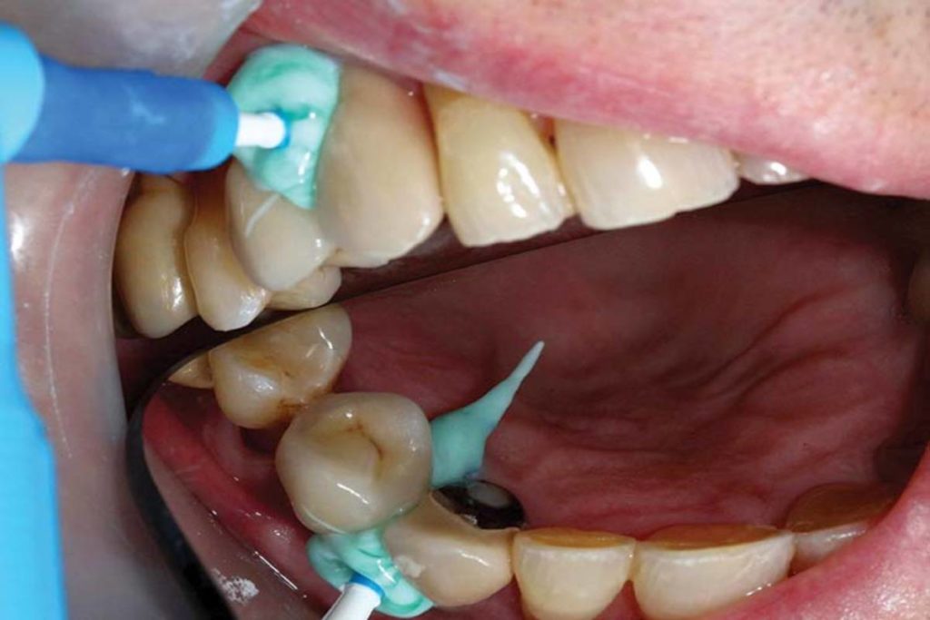 gum disease