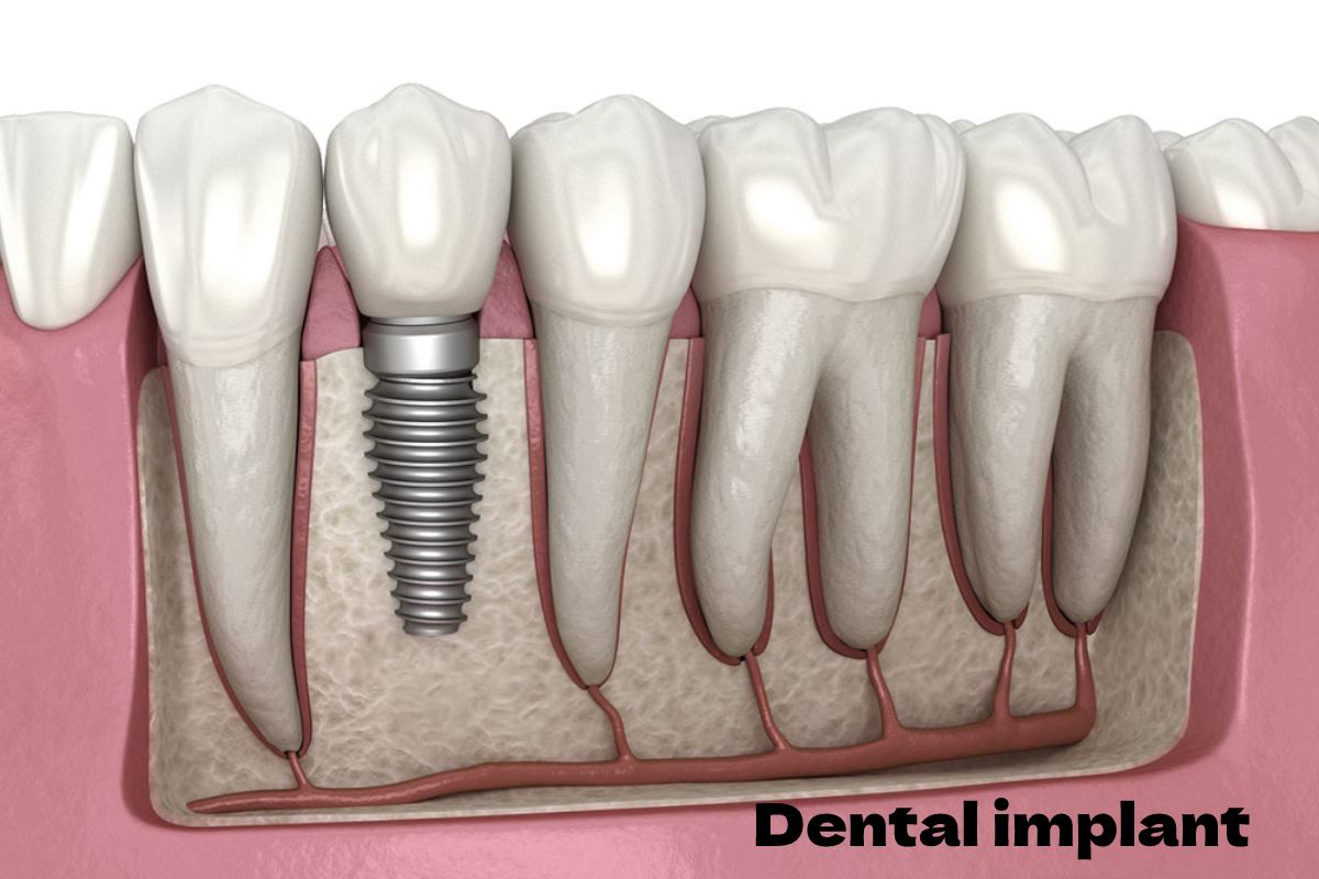  What is Dental Implant? – Definition, 5 Solutions of Dental Implant