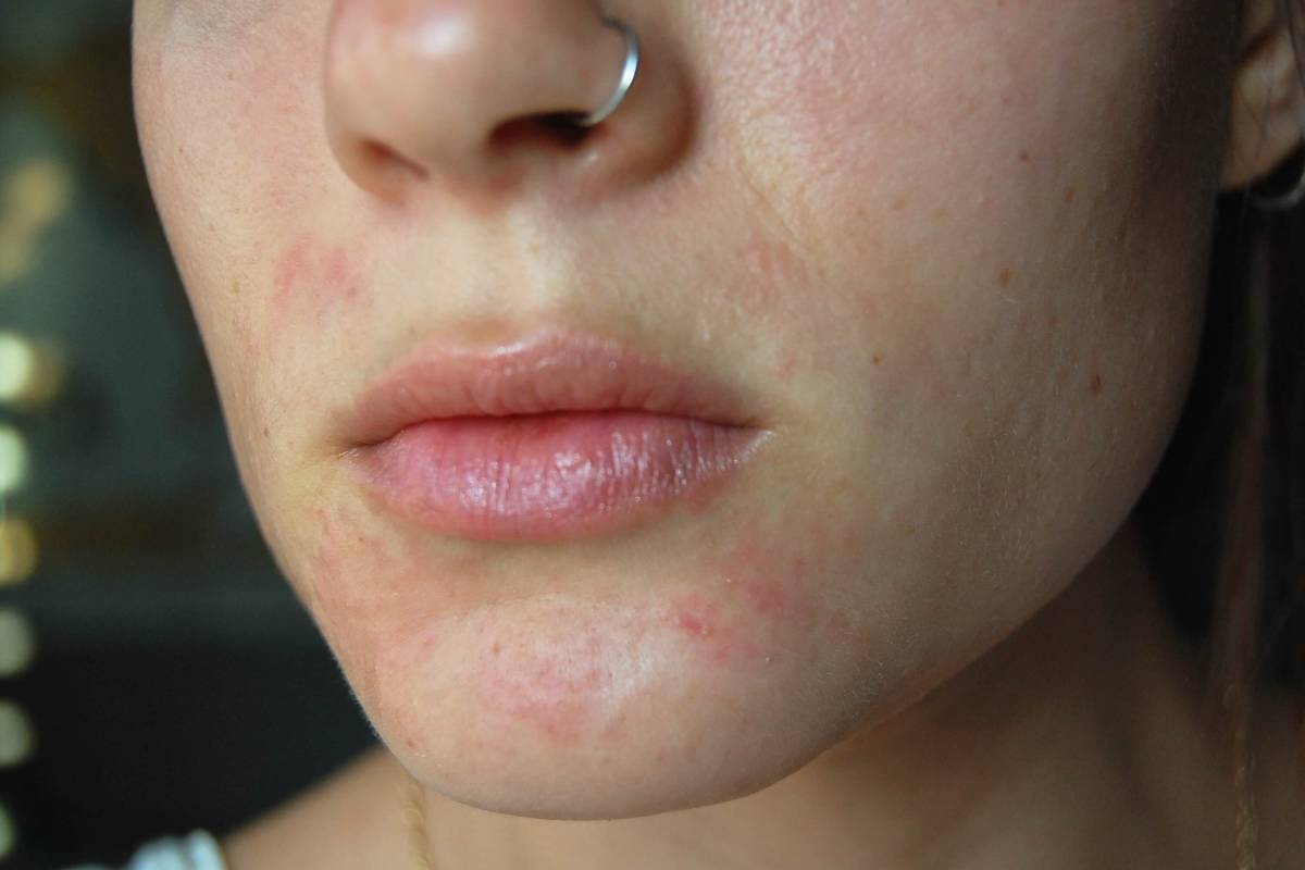 What is the Perioral Dermatitis? – Definition, Causes, Treated