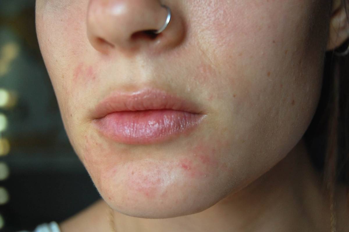 perioral dermatitis