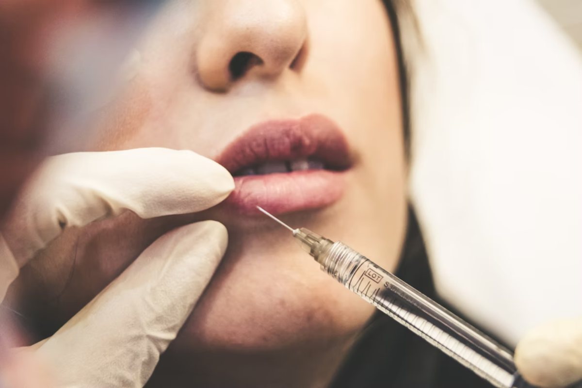 Lip Fillers