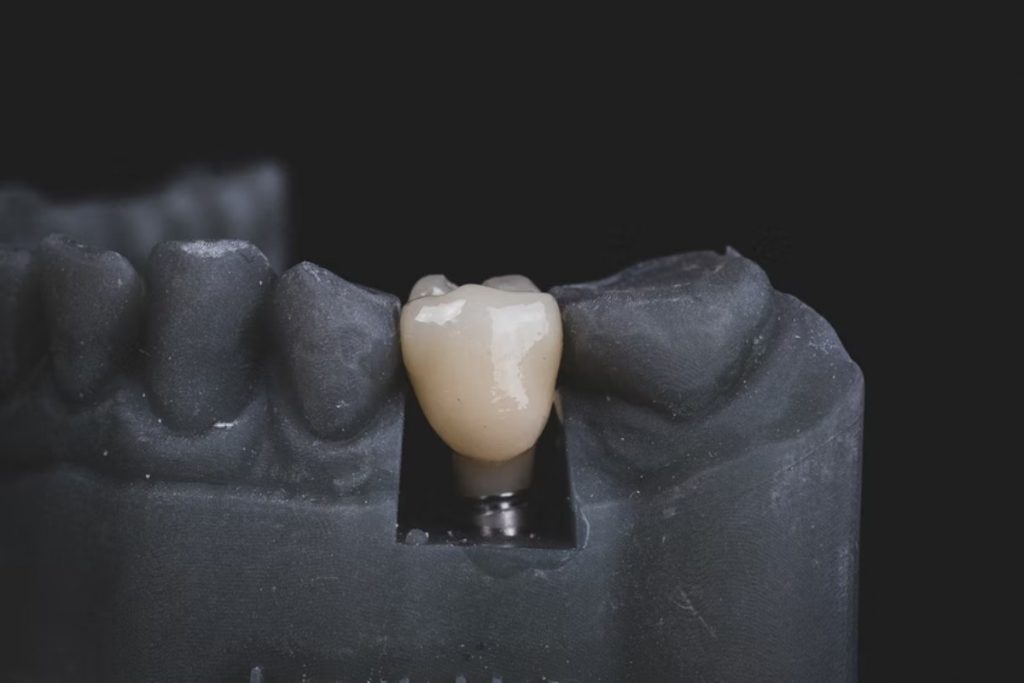 Important Things To Know Before Considering a Dental Bridge