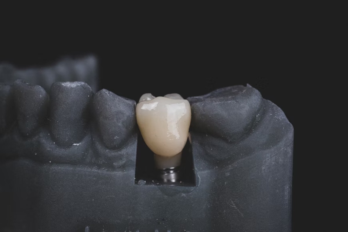  Important Things To Know Before Considering a Dental Bridge