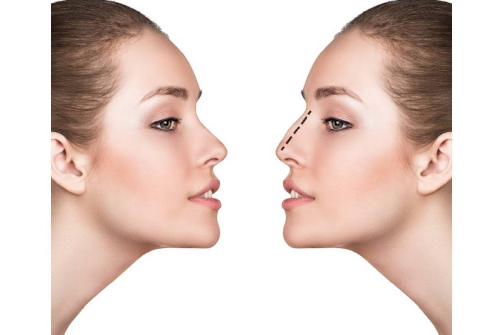 Rhinoplasty