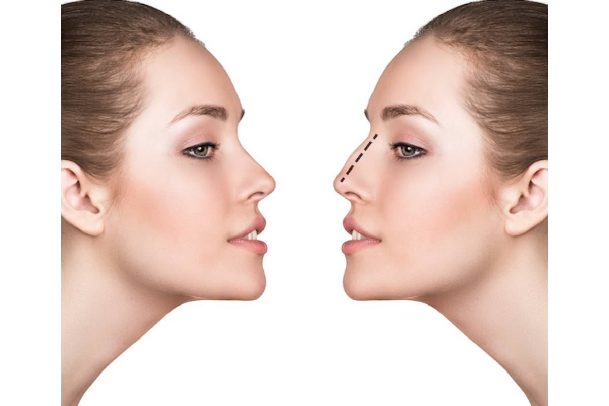  Rhinoplasty Recovery Tips Day by Day