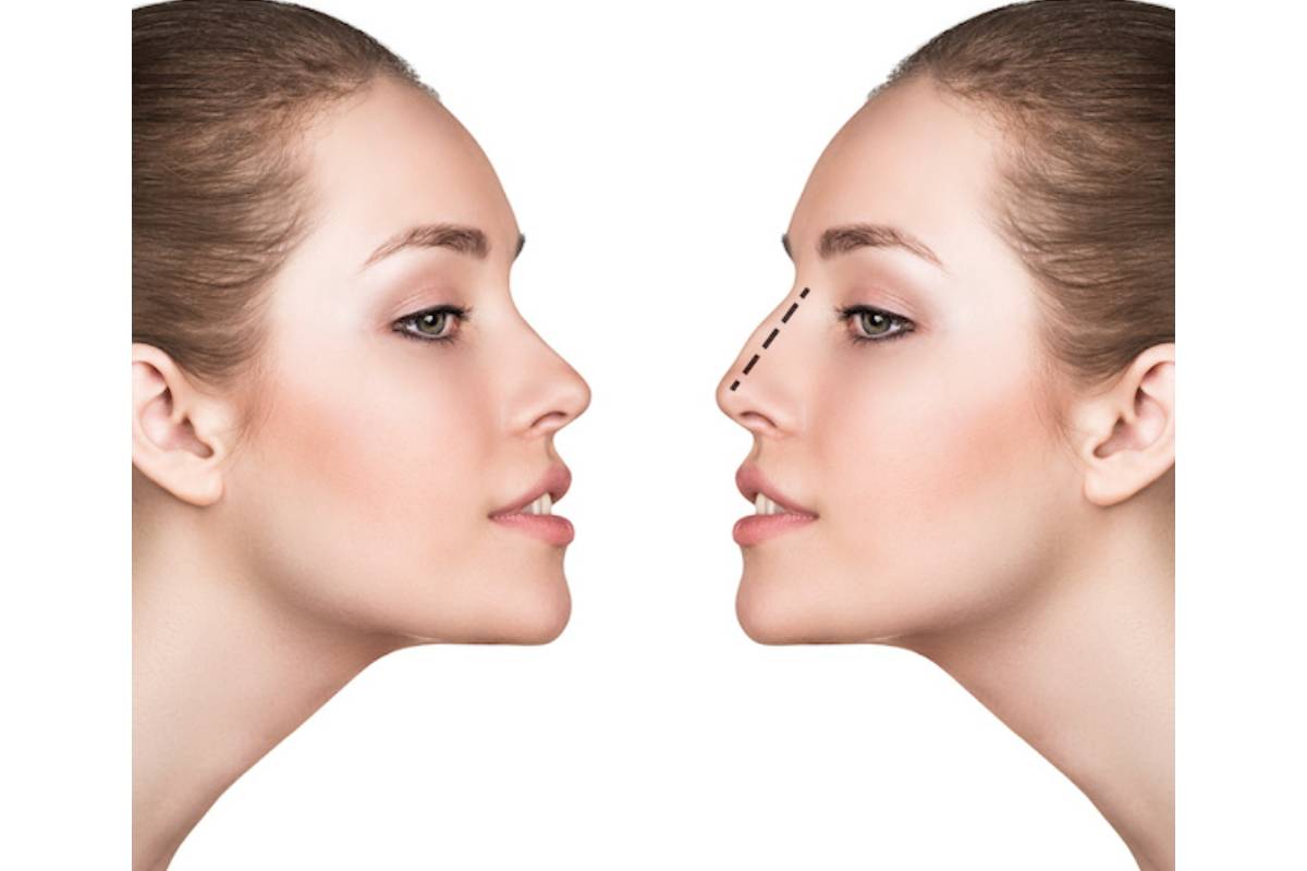 Rhinoplasty Recovery Tips Day by Day