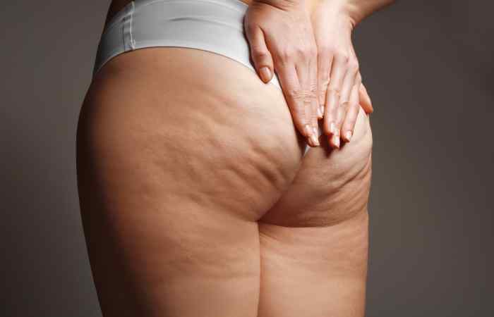 Causes Of Cellulite