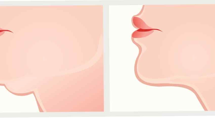 How Facial Liposuction Can Make You Look Younger