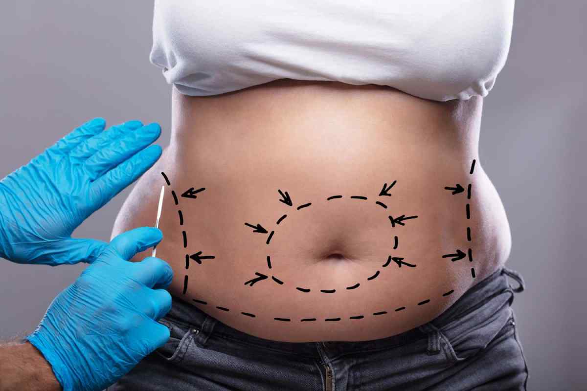 Tummy Tuck Surgery