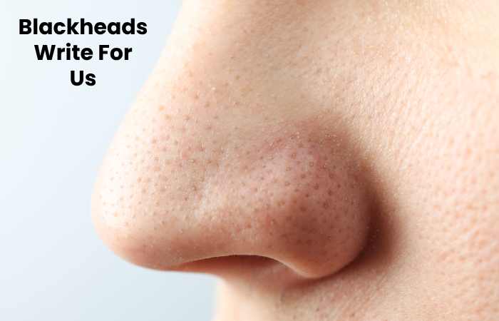 Blackheads Write For Us