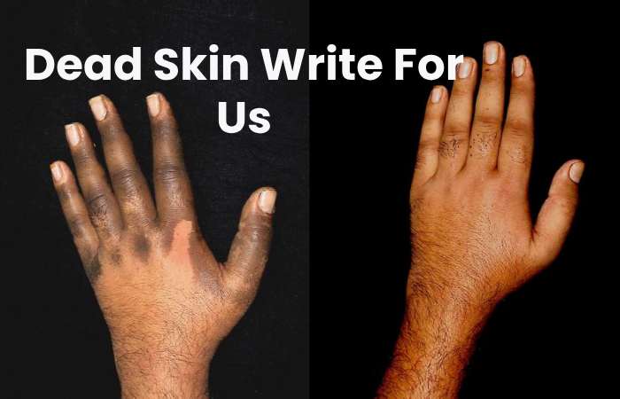 Dead Skin Write For Us