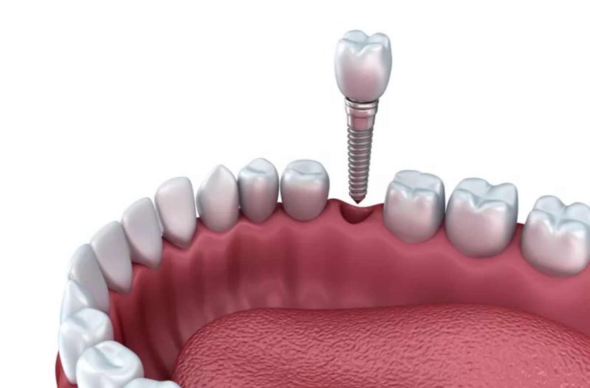  How Long Do Dental Implants Last?