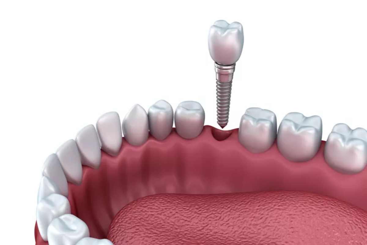 How Long Do Dental Implants Last?