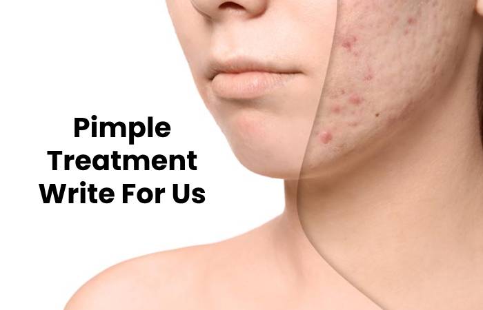 Pimple Treatment Write For Us