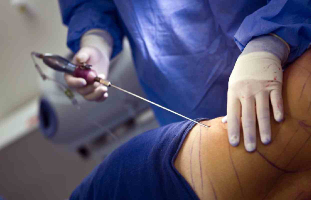 What to Expect From the Liposuction Procedure