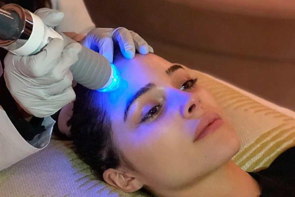 Understanding RF Microneedling