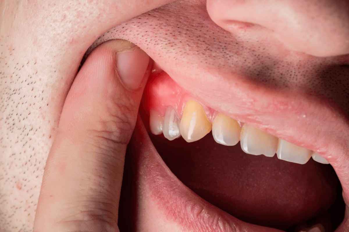 Gum Disease