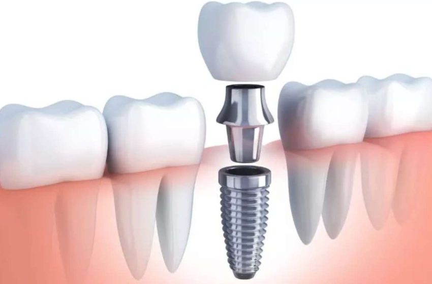 What is Dental Implant? – Definition, 5 Solutions of Dental Implant