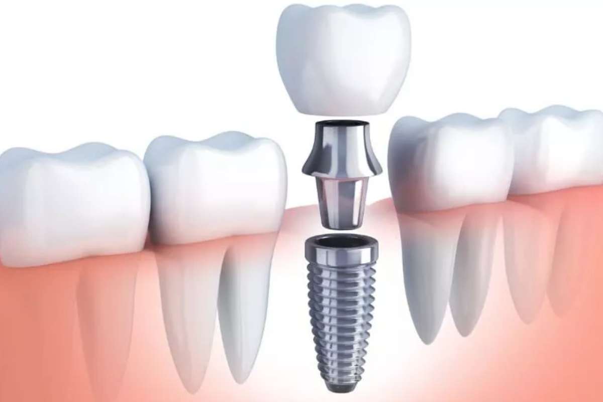 Dental Implant