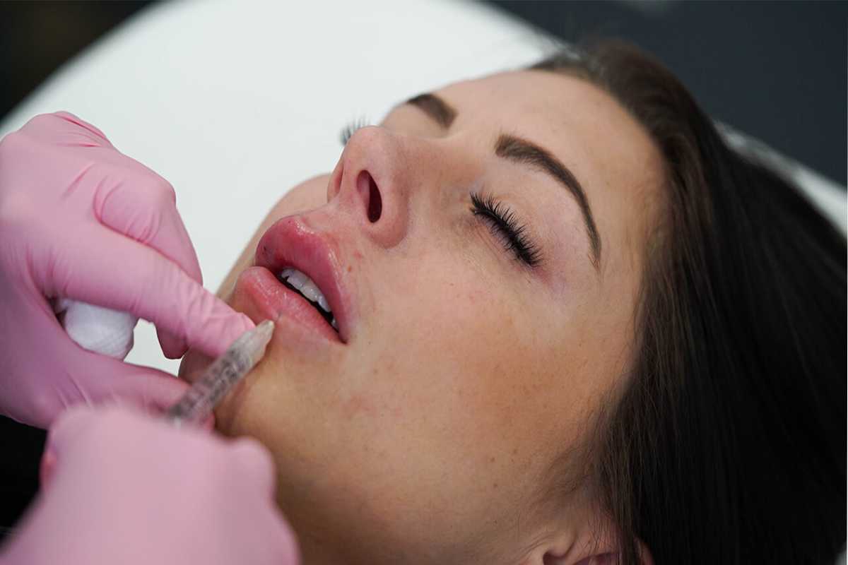 How to Find the Right Place for Lip Fillers in Las Vegas