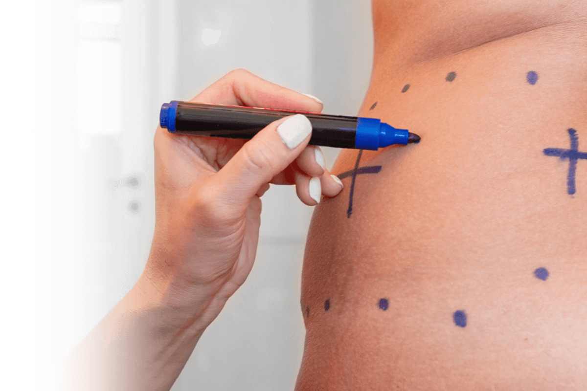 Liposuction