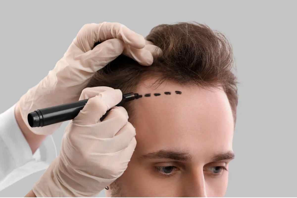 hair transplantation