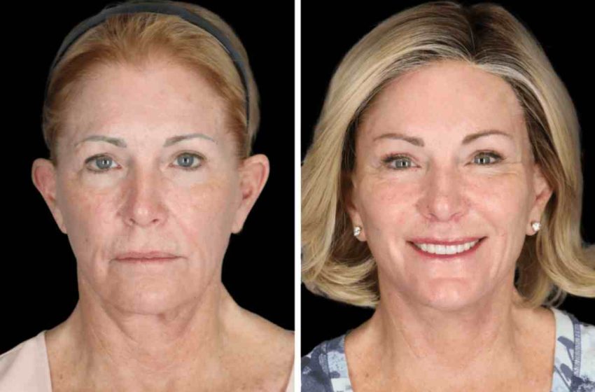 Why Consider Facelift Revision in Beverly Hills?