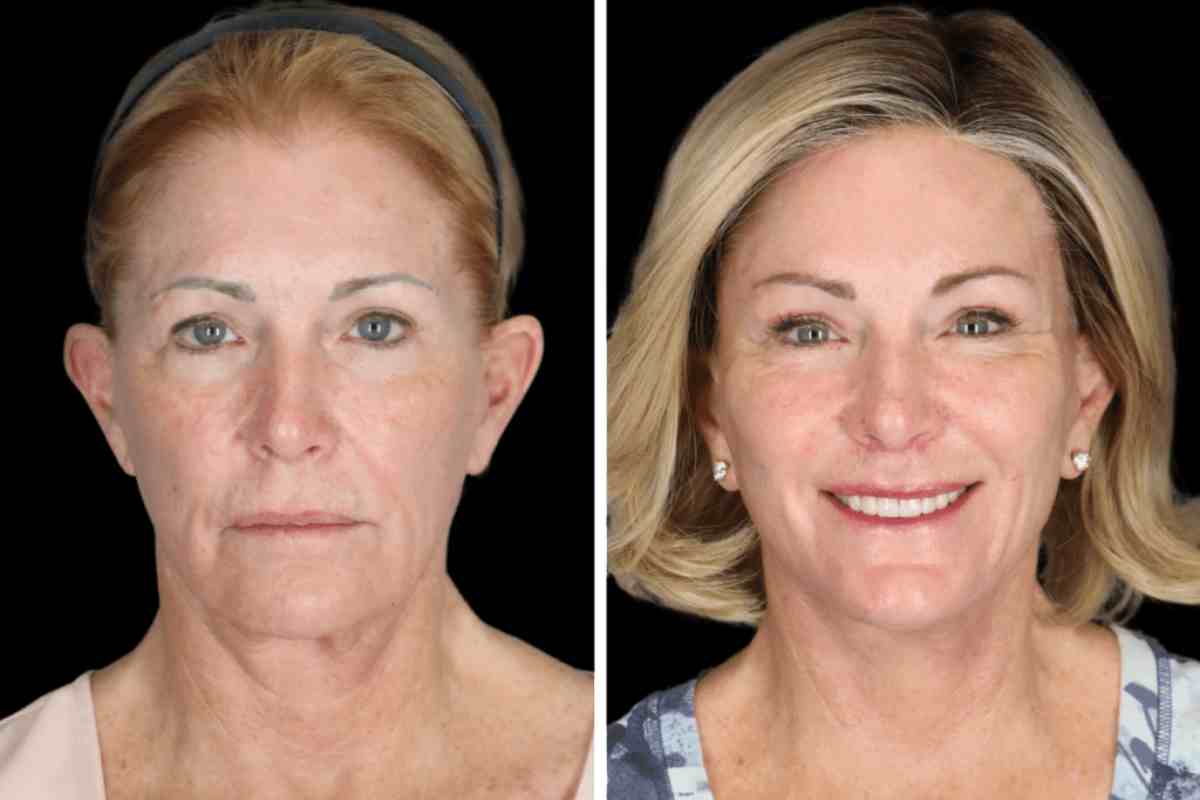 Why Consider Facelift Revision in Beverly Hills_